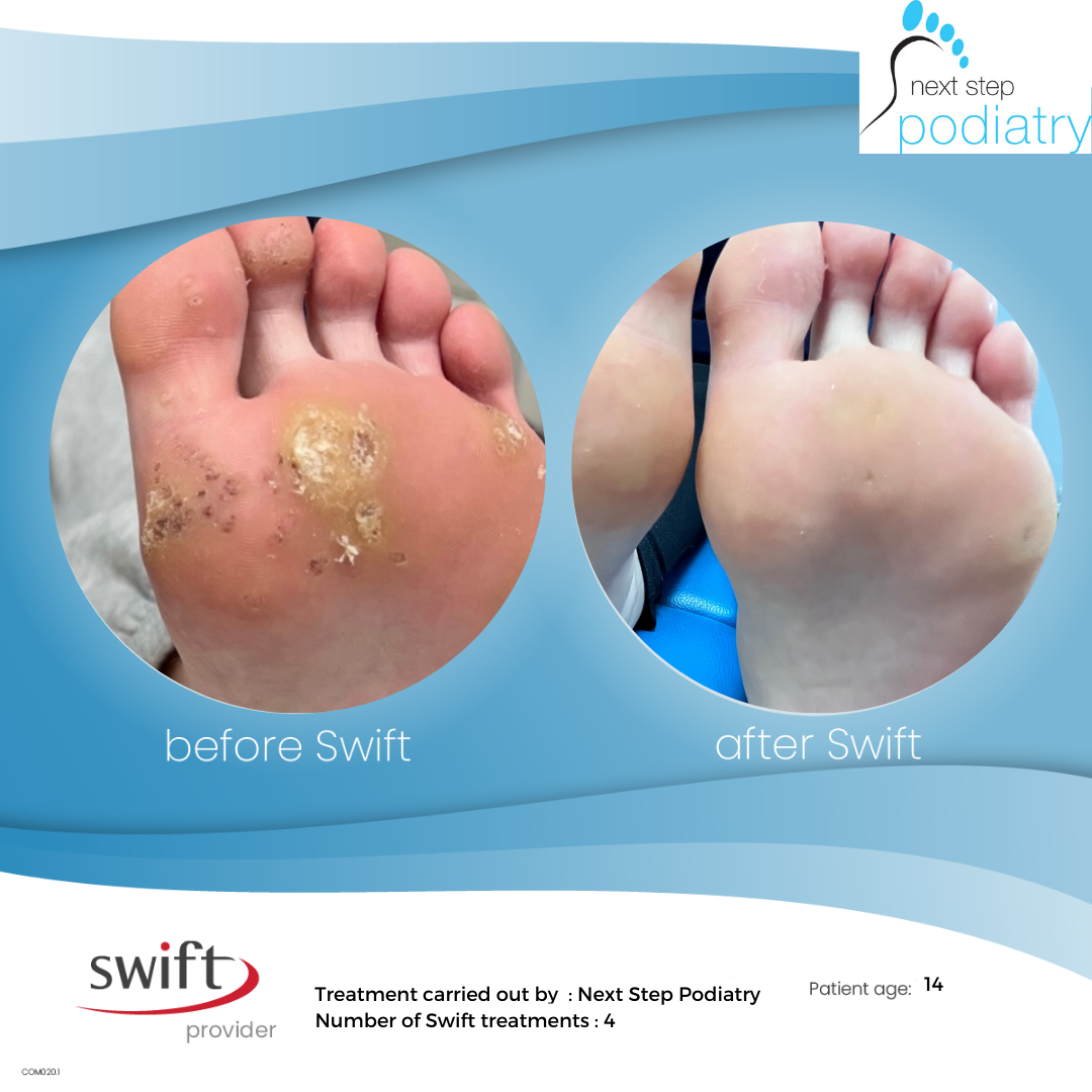 before and after of verruca treatment using swift microwave therapy, the verrucas have all resolved.